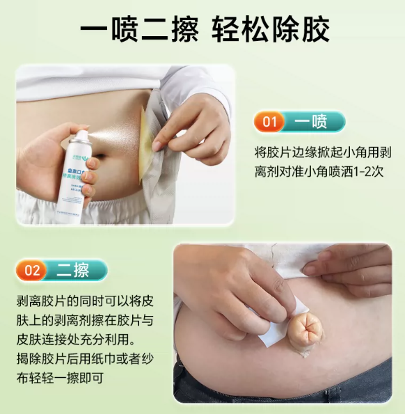 Zaodele stoma glue remover medical glue remover stripper stoma skin care product